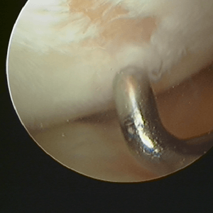 Articular Cartilage Surgery