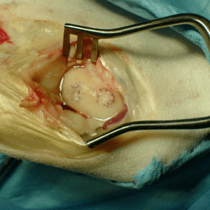 Articular Cartilage Surgery