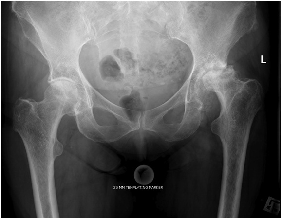Hip Pain and Arthritis