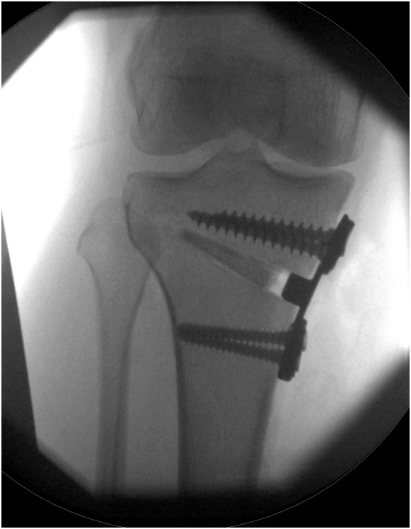 Knee Realignment