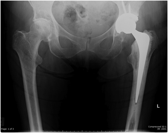 Hip Replacement hip