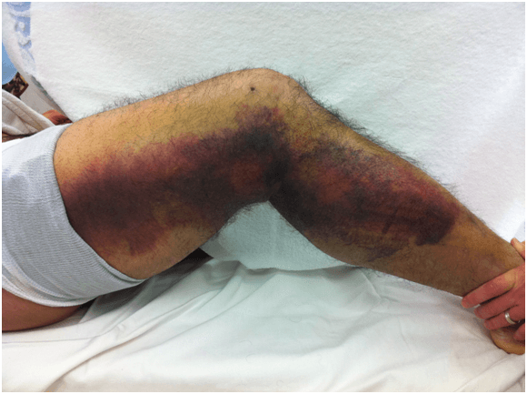 Knee Injury