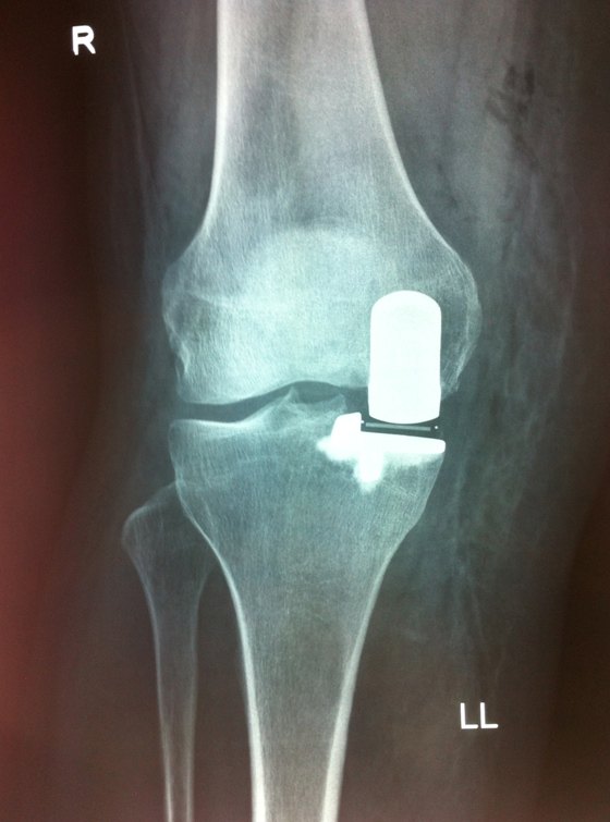 Medial Knee replacement