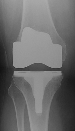 Knee Surgery Knee Surgery