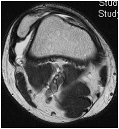 Patella Instability and Dislocations